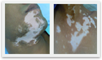 Segmental Vitiligo Features