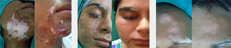 Naive Vitiligo Showing Perfect Results after procedures