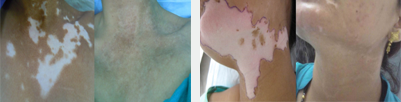 Successful Vitiligo Treatments Images