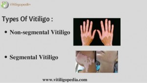 segmental and non segmental vitiligo
