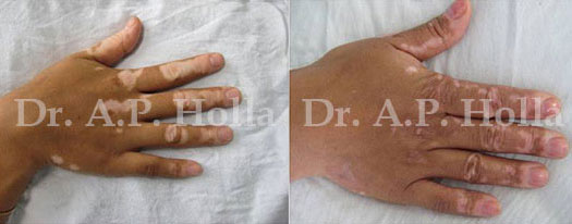 vitiligo ob fingers