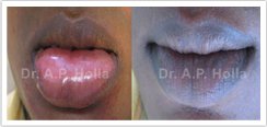 vitiligo-in-lips