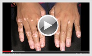 vitiligo-treatment-gallery